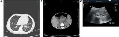 Case Report: Mycoplasma pneumoniae–associated acute pancreatitis